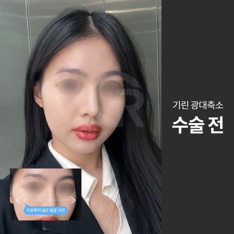 광대가 큰 얼굴, 축소술은 인상을 조율하는 기준점입니다