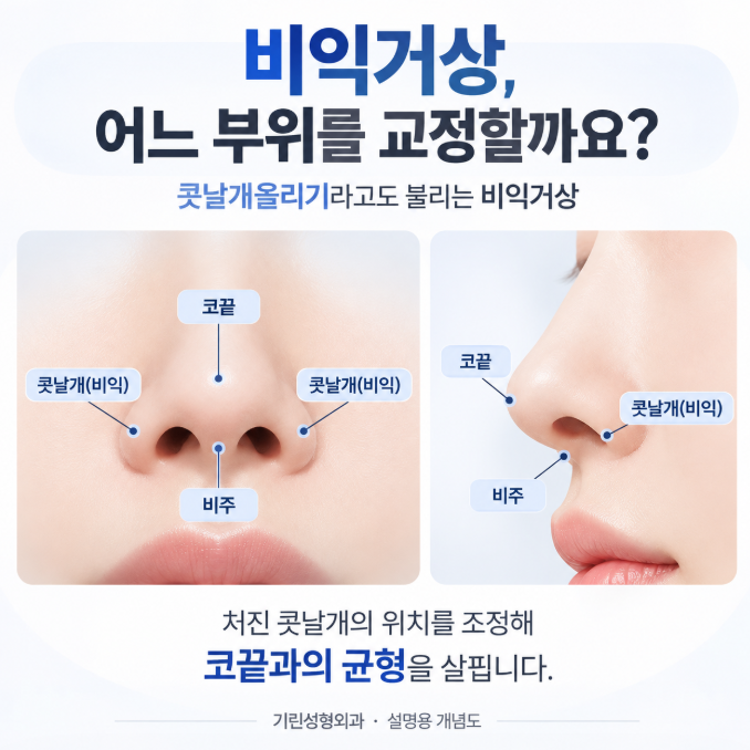 비익거상, 코수술할 때 처진 콧볼을 함께 보는 이유 사진 2